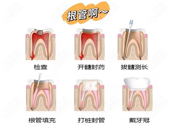 根管治疗三