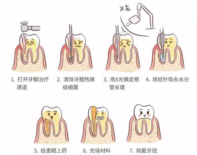 牙髓炎