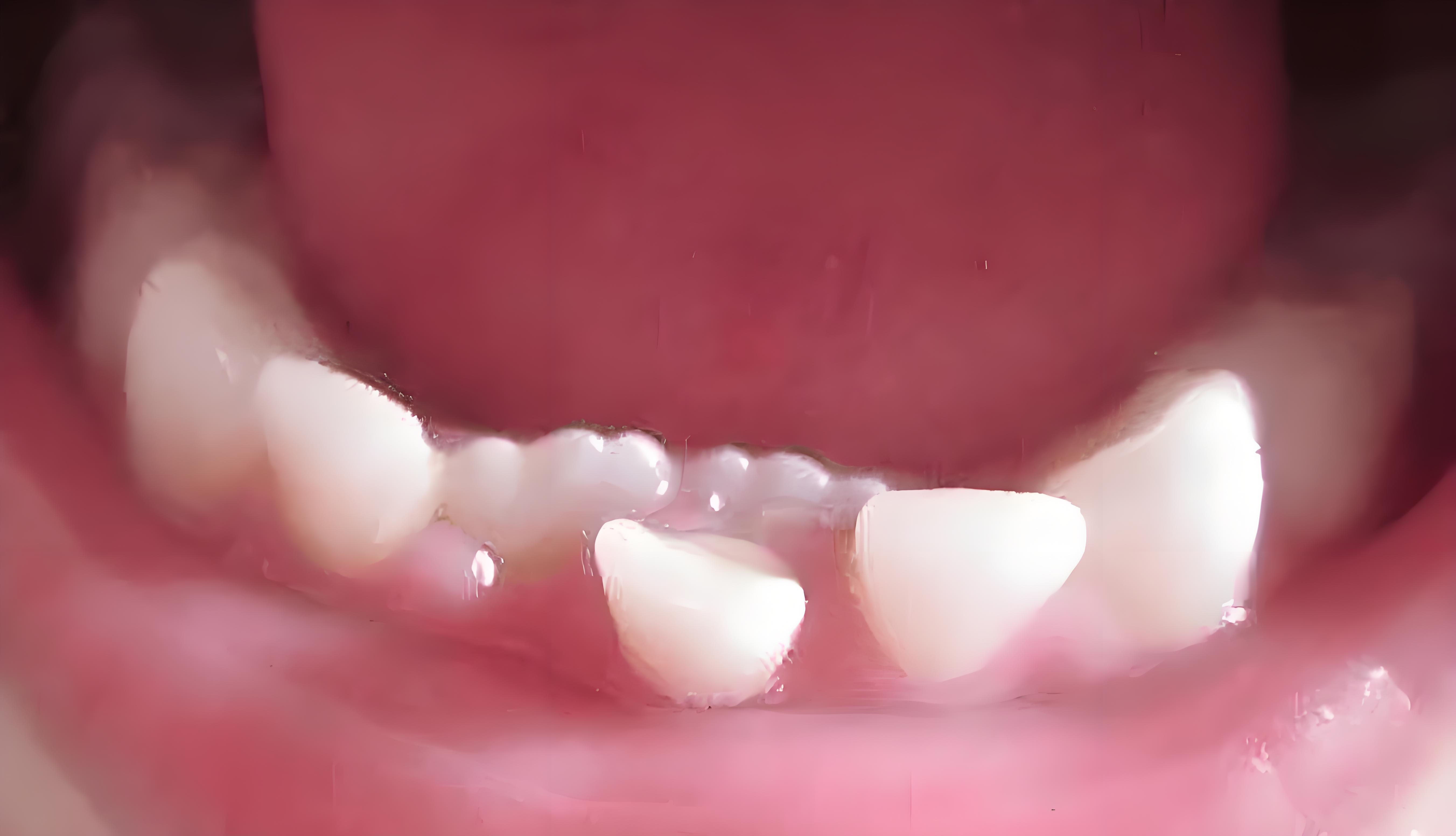 牙齿畸形